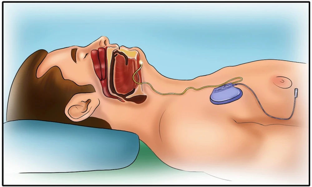 5 Airway Clues Behind Chronic Snoring for Adults in Georgia